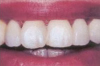 Aufgesetzte Veneers