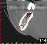 3D-Implantatplanung - Detailaufnahme 4