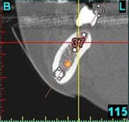 3D-Implantatplanung - Detailaufnahme 5