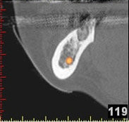 3D-Implantatplanung - Detailaufnahme 9