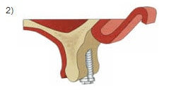 Implantologie: Knochenaufbauten - Abb. 02