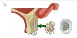Implantologie: Knochenaufbauten - Abb. 03
