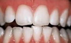 Bleaching beim Zahnarzt Zähne nach einem Bleaching