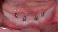 Eingesetzte Mini-Dental-Implantate