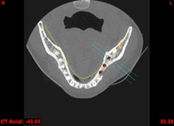 Computerdarstellung des Kiefers mit geplanter Implantatposition