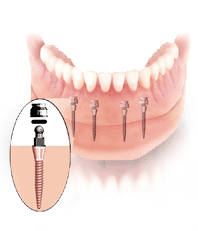 Modelldarstellung der Implantatpositionen