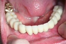 Implantatgetragener Zahnersatz - Zahnarzt Braunschweig Implantatgetragener Zahnersatz - Zahnarzt Braunschweig