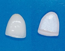 Veneers Veneers