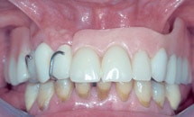 Herausnehmbarer Zahnersatz