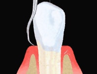 Zahnfleischtaschen ausschaben - Schematische Darstellung
